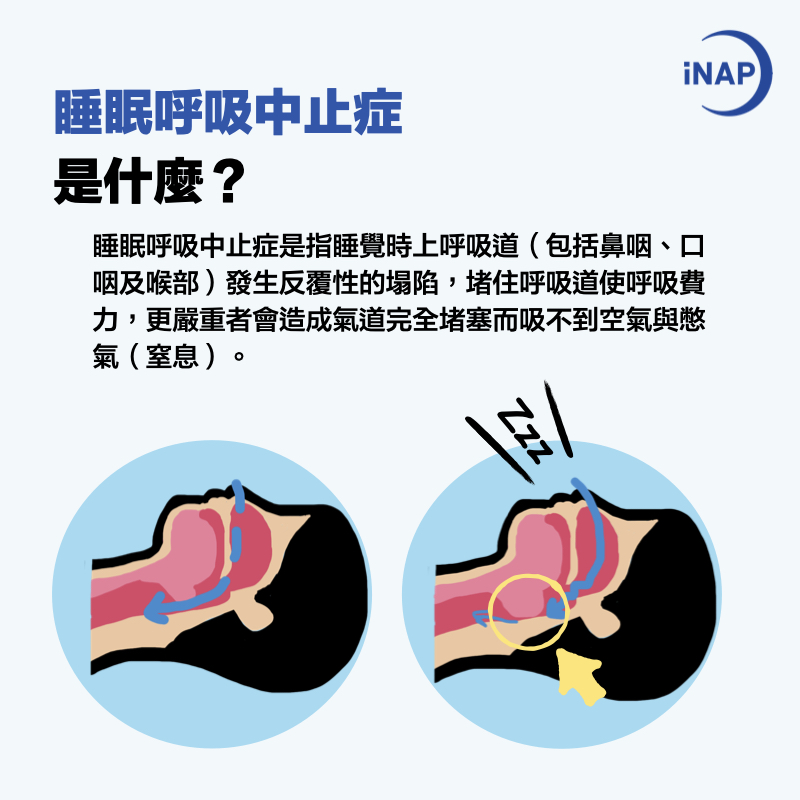 什麼是睡眠呼吸中止症